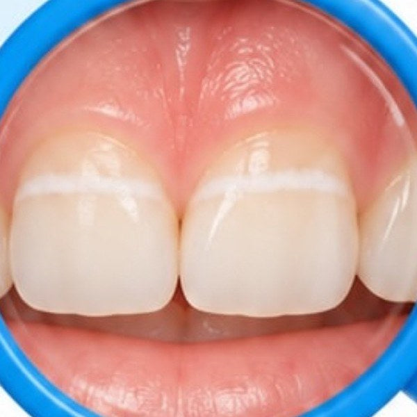Close-up of front teeth with a chalky white line along the gum